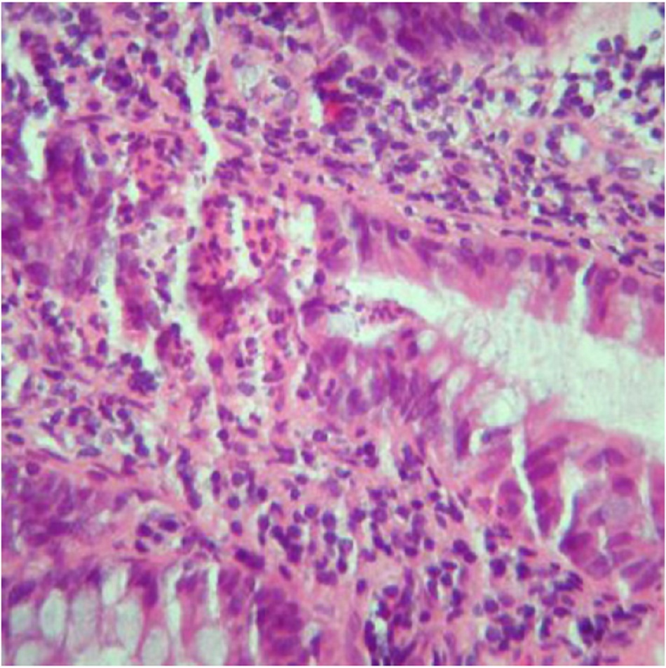 Hình 9: Viêm hốc và áp-xe nang với biến dạng hình thái của nang đi kèm viêm và nhiều tế bào bạch huyết và bào tương