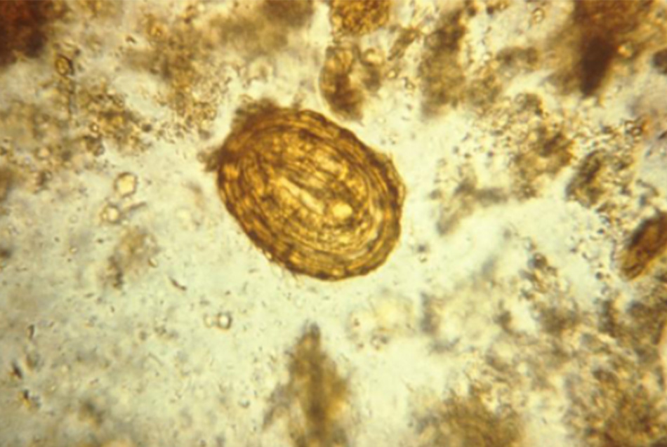 Hình 4: Photomicrograph depicting a fertilised egg of the parasite Ascaris lumbricoides