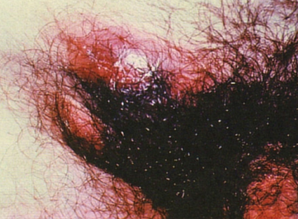 Hình 2: Bệnh hạch bạch huyết vùng bẹn và vùng đùi, biểu hiện thứ hai của bệnh hột xoài Hình ảnh từ Ronald Ballard, sao chép với sự cho phép từ Chẩn đoán và Điều trị nhiễm trùng lây qua đường tình dục ở Nam Phi, ấn bản thứ 3, Johannesburg, Viện nghiên cứu y khoa Nam Phi, 2000