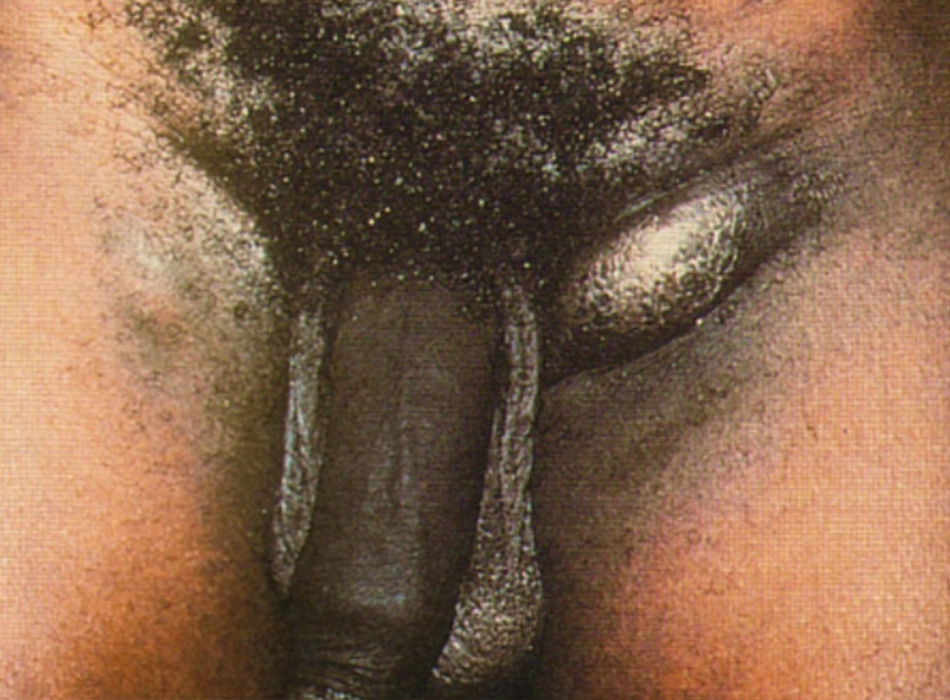 Hình 3: Một trong những triệu chứng của giai đoạn thứ ba của bệnh hột xoài là sẹo và xơ hóa hạch do viêm mạn tính. Hình ảnh từ Ronald Ballard, sao chép với sự cho phép từ Chẩn đoán và Điều trị nhiễm trùng lây qua đường tình dục ở Nam Phi, ấn bản thứ 3, Johannesburg, Viện nghiên cứu y khoa Nam Phi, 2000