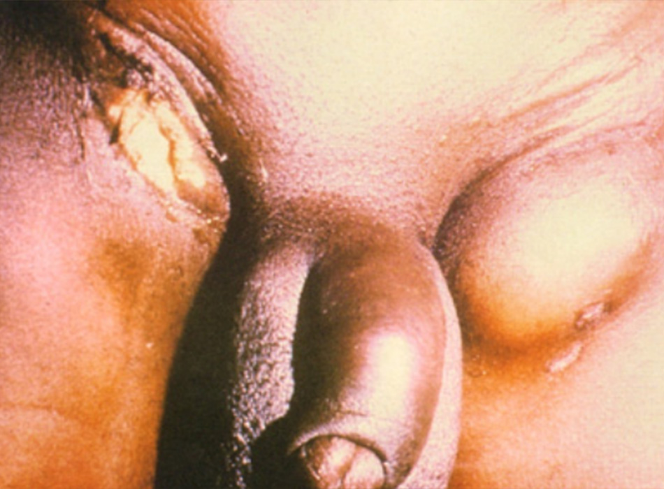 Hình 4: Phù bạch mạch vùng sinh dục với áp-xe và hình thành lỗ rò Hình ảnh từ Ronald Ballard, sao chép với sự cho phép từ Chẩn đoán và Điều trị nhiễm trùng lây qua đường tình dục ở Nam Phi, ấn bản thứ 3, Johannesburg, Viện nghiên cứu y khoa Nam Phi, 2000
