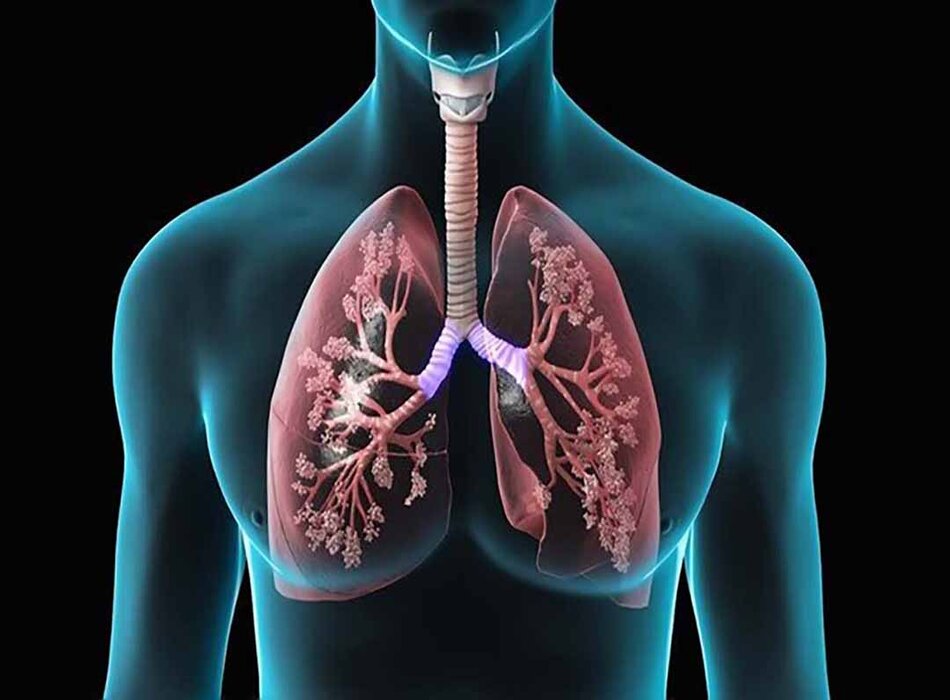 Bệnh lao phổi: Nguyên nhân, dấu hiệu nhận biết, chẩn đoán và cách điều trị theo BMJ