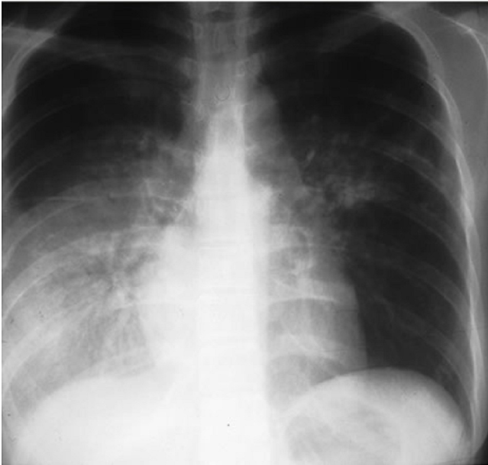 Hình 2: Các hình ảnh mờ ở thùy dưới phải trên bệnh nhân lao phổi và đái tháo đường