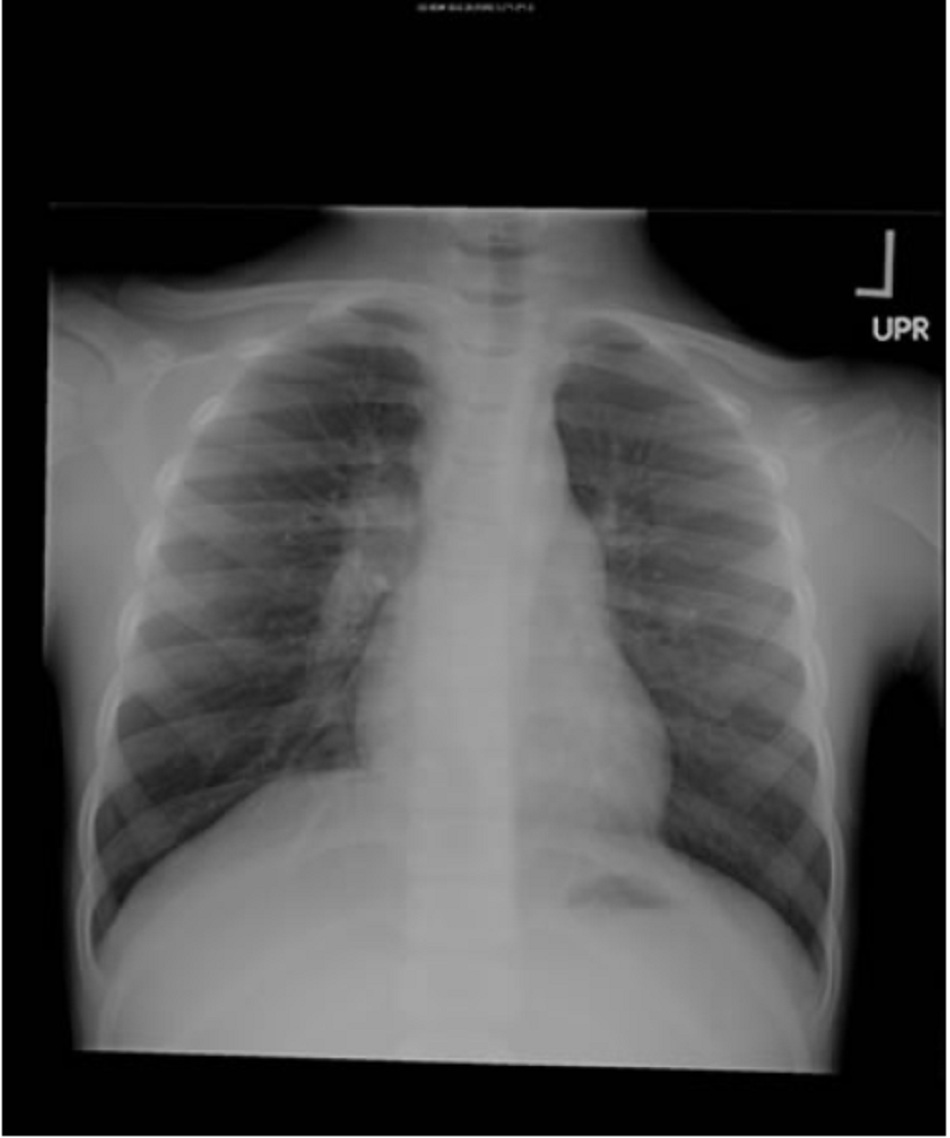 Hình 3: Hạch rốn phổi phải ở bệnh nhi