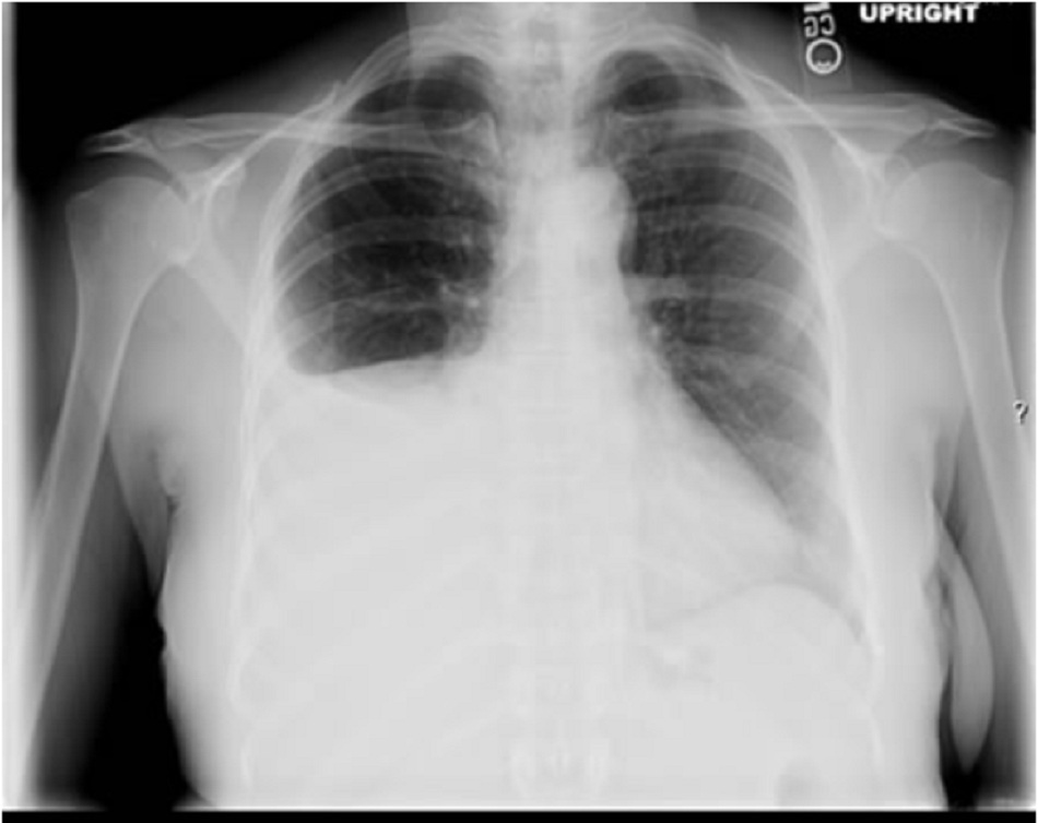 Hình 4: Tràn dịch màng phổi phải