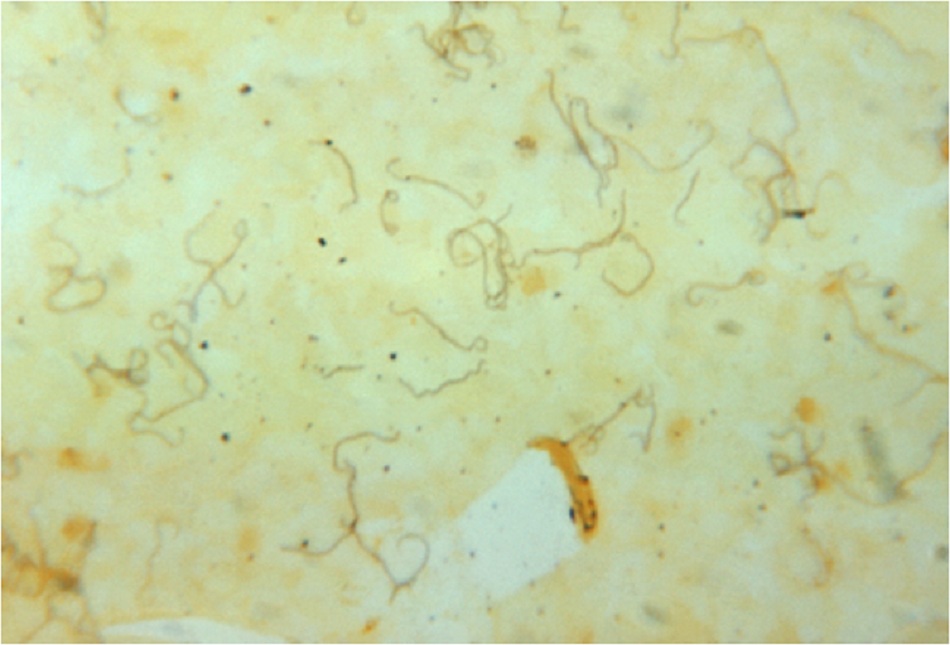 Hình 2: Nhuộm bạc trên mảnh sinh thiết gan cho thấy hình ảnh leptospira