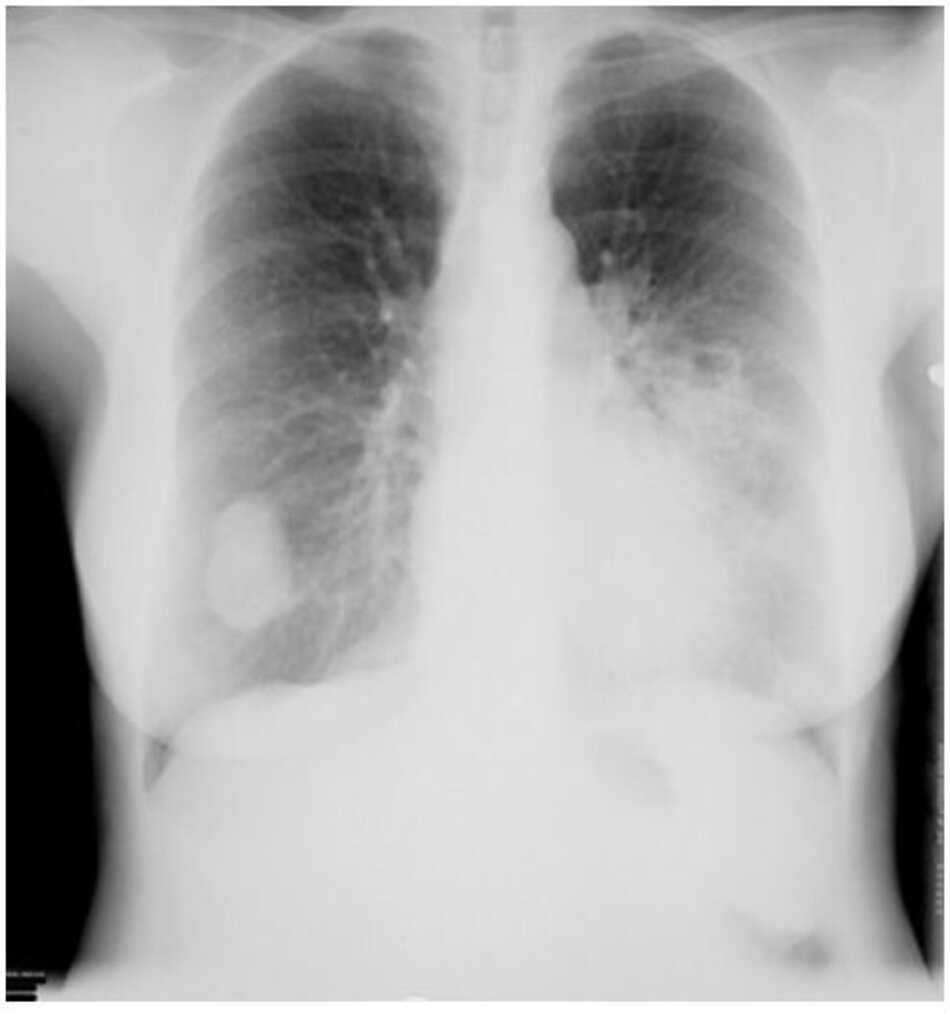  Hình 2: Các nốt phổi ở thùy dưới bên phải và thùy dưới bên trái thứ phát sau nấm Cryptococcus neoformans