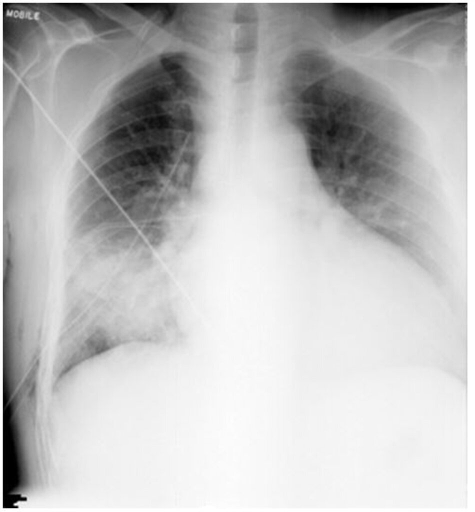 Hình 3: Viêm phổi đông đặc thứ phát hai đáy do Cryptococcus neoformans