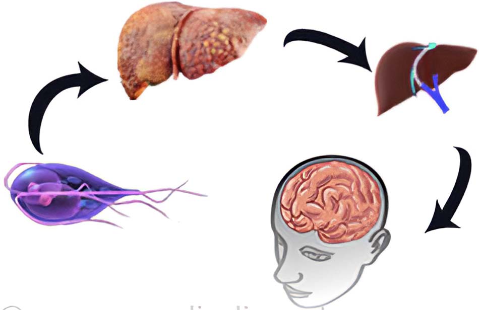 Bệnh não gan: Nguyên nhân gây bệnh, chẩn đoán và điều trị