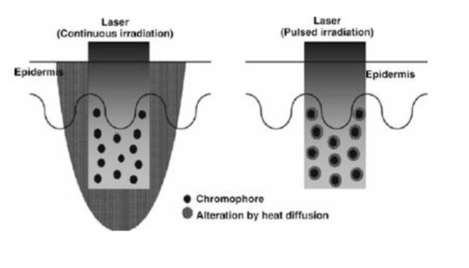 Hình 1.31 Một sơ đồ cho thấy sự khác biệt giữa các liệu pháp laser thông thường sử dụng chiếu xạ liên tục và quá trình quang nhiệt chọn lọc khi sử dụng chiếu xạ dạng xung.