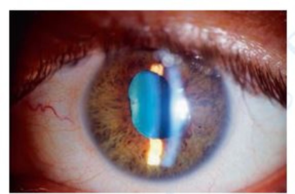 Hình 1.42 Tổn thương đồng tử ở mắt trái sau khi triệt lông mày bằng laser diode.
