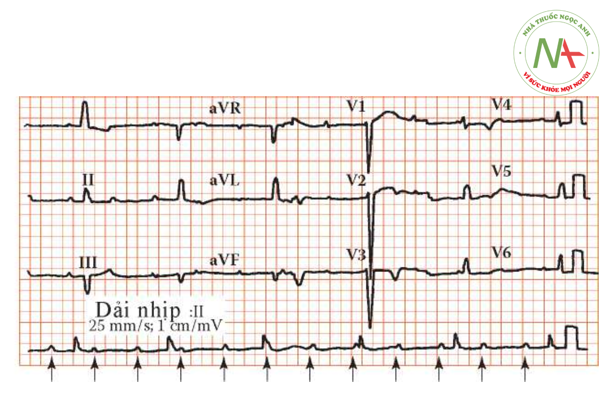 Hình 2. Điện tâmđồ block tim hoàn toàn, mũi tên chỉ
sóng P.