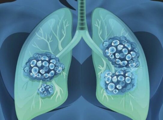 Đặc tính của tái huy động- không tái huy động phổi và việc thực hành chúng trong quản lí ARDS