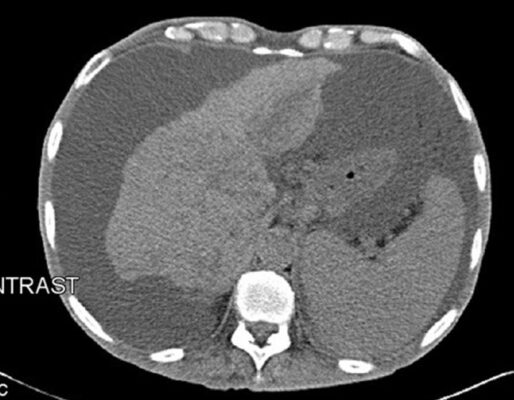 Hình 3: Chụp CT vùng bụng chỉ ra cổ trướng nặng do xơ gan và ung thư biểu mô tế bào gan