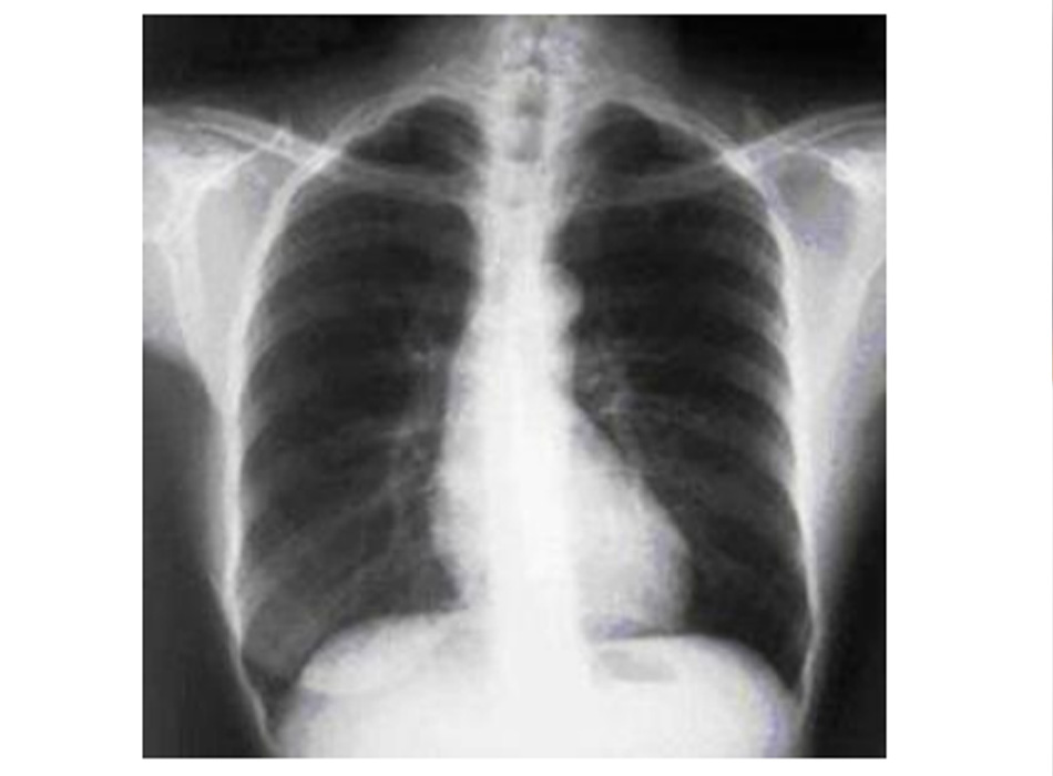 Hình 1: XQ ngực thẳng cho thấy phổi giãn nở quá mức ở bệnh nhân bị COPD. Phổi giãn nỡ quá mức gây ra do tình trạng khí phế thũng của COPD, hơn là do viêm phế quản mạn tính vốn là nguyên nhân tiềm ẩn của các triệu chứng ho Từ thông tin thu thập cá nhân của Tiến sĩ M. A. Sharifabadand, SUNY tại Trường Y của Đại học Stony Brook, Khoa Bệnh Phổi và Chăm sóc Tích cực, Mineola, New York và Tiến sĩ J. P. Parsons, Trung tâm Y khoa Đại học Tiểu bang Ohio, Columbus; đã được cho phép sử dung
