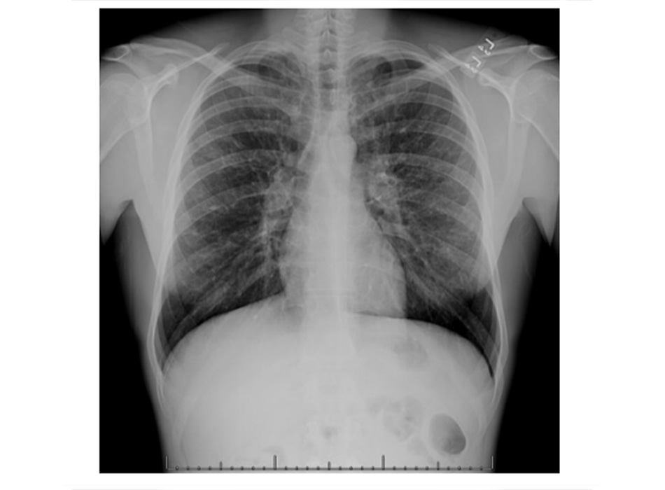 Hình 10: XQ ngực thẳng thấy giãn và dày đường thở ở bệnh nhân bị giãn phế quản Từ thông tin thu thập cá nhân của Tiến sĩ S.M. Bhorade, Trung tâm Y khoa Đại học Chicago; đã được phép sử dụng