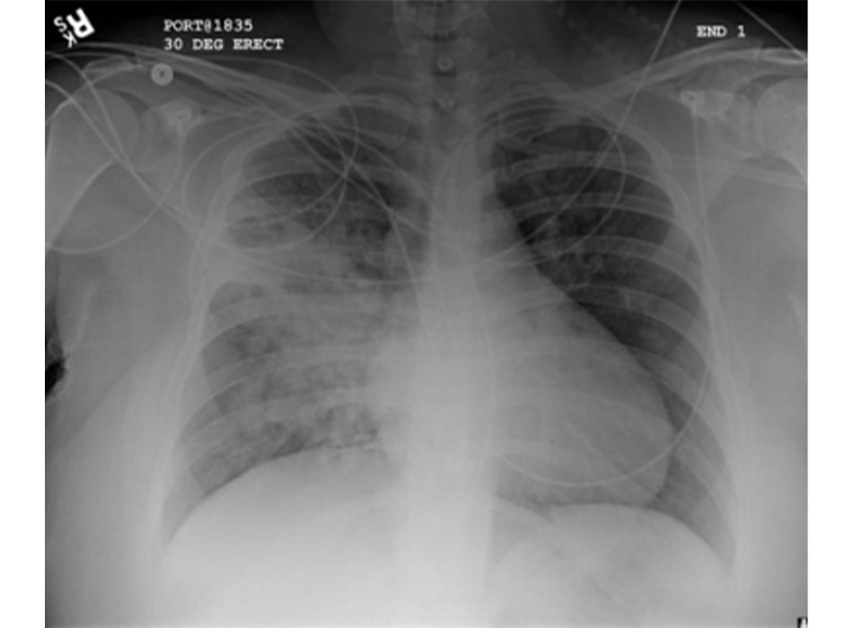 Hình 11: XQ ngực thẳng thấy tăng đậm vùng quanh rốn phải và phân thùy trên của thùy trên và dưới phổi phải tương ứng với tình trạng viêm phổi hít nặng hơn Từ thông tin thu thập cá nhân của Tiến sĩ R. Kanner, Trường Y Đại học Utah