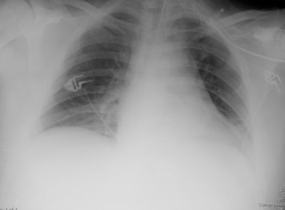 Hình 12: XQ ngực thẳng di động thấy mờ đục ở hai đáy phổi, bên phải nặng hơn bên trái, ở bệnh nhân bị viêm phổi mắc phải tại bệnh viện Từ thông tin thu thập cá nhân của Tiến sĩ F. W. Arnold, Bộ phận Bệnh Truyền nhiễm, Khoa Y, Trường Y Đại học Louisville