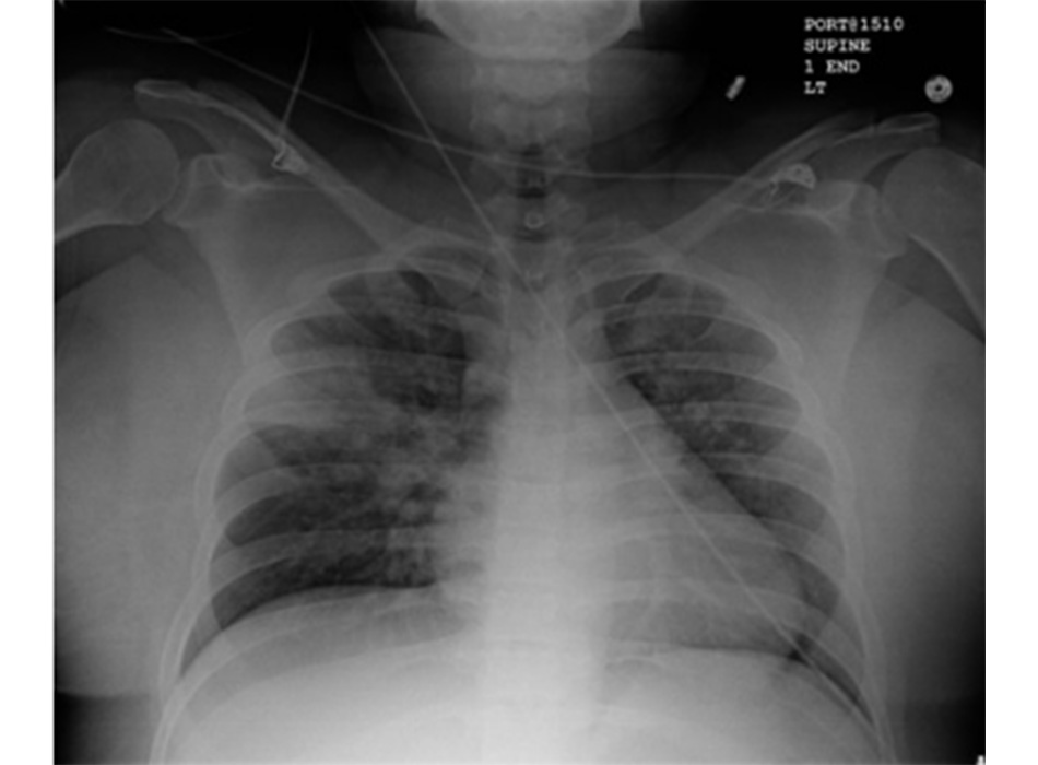 Hình 13: XQ ngực thẳng cho thấy các vùng mờ đục không rõ ranh giới ở thùy trên bên phải trên rãnh nhỏ phù hợp với những thay đổi sớm của bệnh viêm phổi hít Từ thông tin thu thập cá nhân của Tiến sĩ R. Kanner, Trường Y Đại học Utah