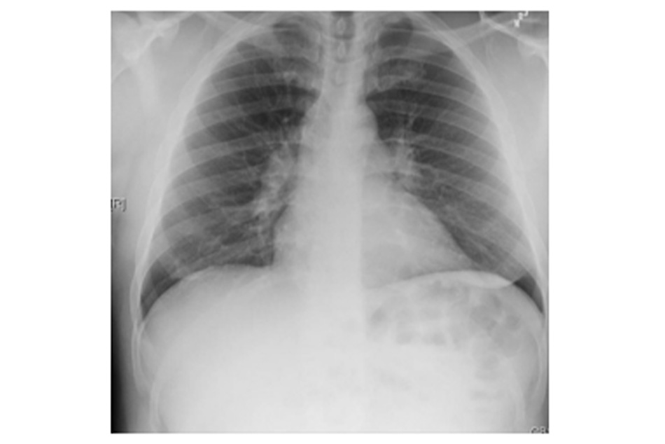Hình 15: XQ ngực thẳng cho thấy hạch bạch huyết ở rốn phổi hai bên ở bệnh nhân bị bệnh sarcoid Từ thông tin thu thập cá nhân của Tiến sĩ M.P. Muthiah, Khoa Bệnh phổi, Chăm sóc Tích cực và Giấc ngủ, Đại học Tennessee