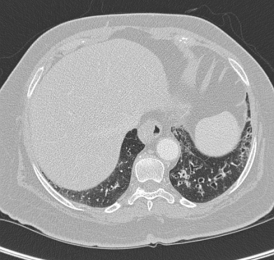 Hình 16: Chụp CT cho thấy hình ảnh vòng nhẫn bên trái của bệnh nhân bị giãn phế quản