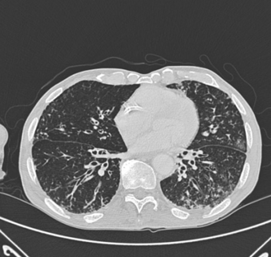 Hình 17: Chụp CT ngực thấy đường thở giãn và dày và hình ảnh chồi cây ở ngoại biên trên bệnh nhân bị giãn phế quản Từ thông tin thu thập cá nhân của Tiến sĩ S.M. Bhorade, Trung tâm Y khoa Đại học Chicago; đã được phép sử dụng