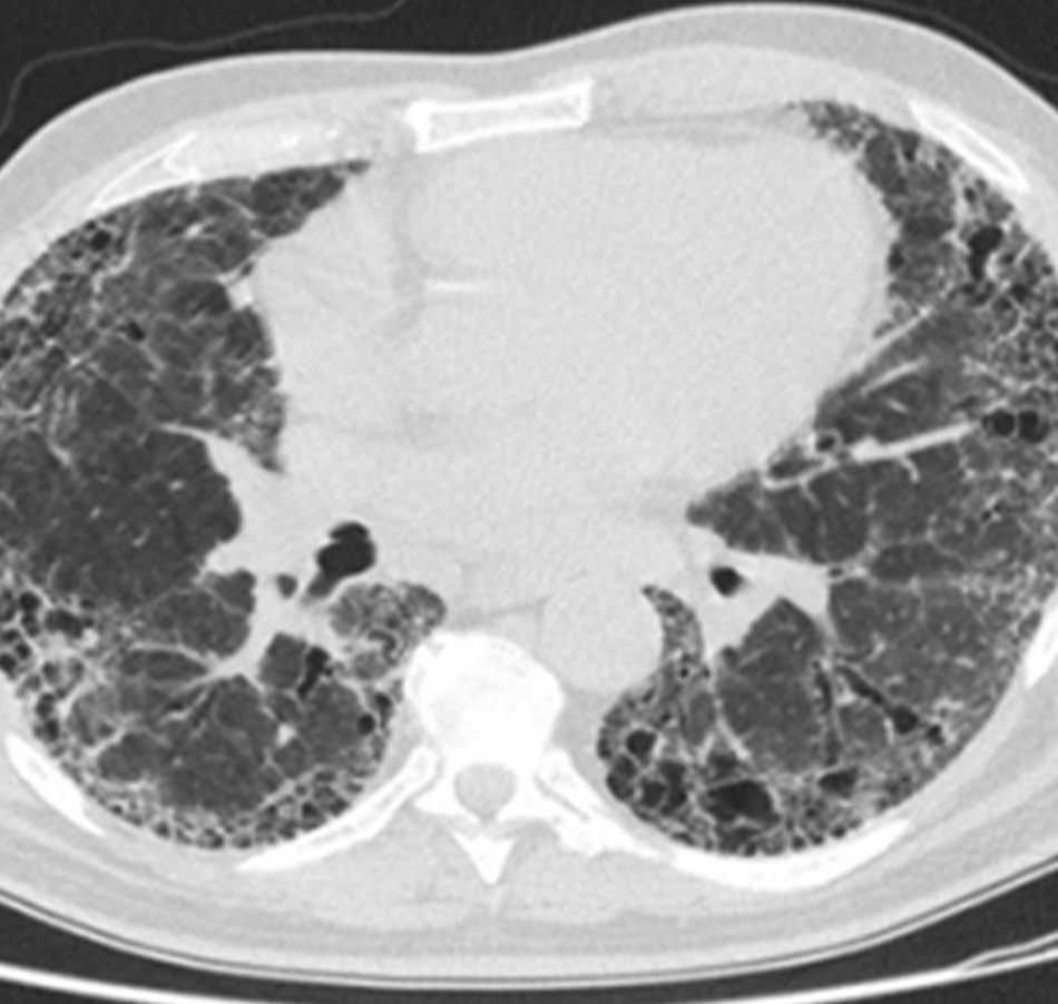 Hình 18: Chụp CT thấy tình trạng xơ hóa phổi vô căn Từ thông tin thu thập cá nhân của Tiến sĩ J.C. Munson, Trung tâm Sinh thống kê học và Dịch tễ học Lâm sàng, Trường Y Đại học Pennsylvania