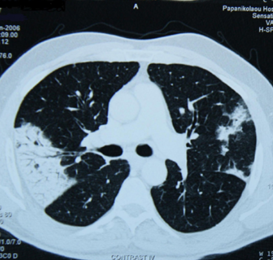 Hình 19: Chụp CT ngực một bệnh nhân bị ngộ độc phổi do amiodarone, thấy các đám mờ không cân xứng, ưu thế phân bố vùng ngoại vi Từ thông tin thu thập cá nhân của Tiến sĩ A. Pataka và Giáo sư P. Argyropoulou, Đại học Aristotle, Thessaloniki, Hy Lạp