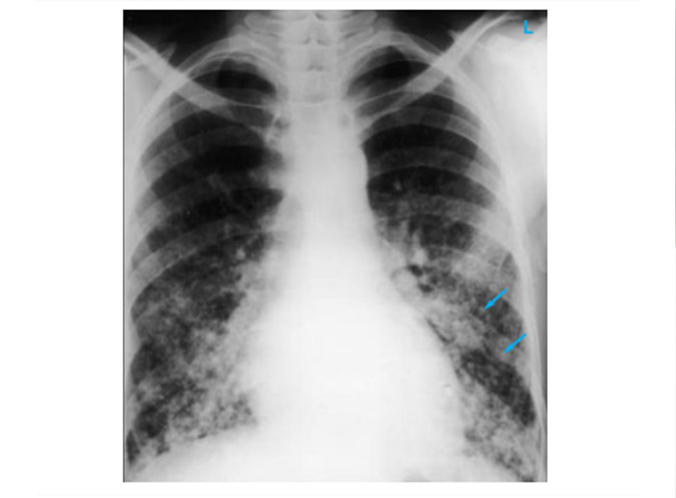 Hình 2: XQ ngực thẳng chỉ ra di căn phổi dạng nốt hạt kê (mũi tên). Khối u nguyên phát là ung thư biểu mô tuyến giáp E. Dick, Student BMJ. 2001;9:10-12