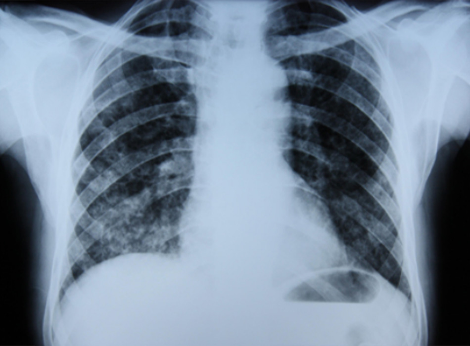Hình 6: XQ ngực thẳng cho thấy tình trạng xơ hóa mô kẽ ở bệnh nhân bị ngộ độc phổi do amiodarone Từ thông tin thu thập cá nhân của Tiến sĩ A. Pataka và Giáo sư P. Argyropoulou, Đại học Aristotle, Thessaloniki, Hy Lạp; đã được phép sử dụng