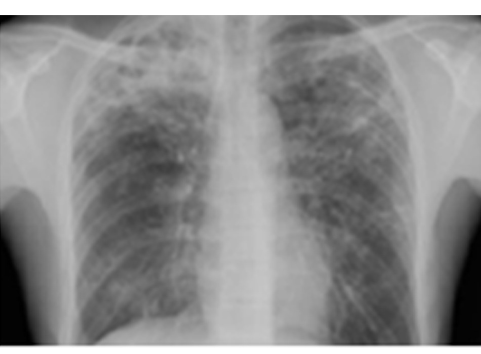 Hình 7: XQ ngực thẳng cho thấy bệnh lao phổi có tạo hang Từ thông tin thu thập cá nhân của Tiến sĩ M. Narita, Khoa Bệnh phổi và Chăm sóc Tích cực, Đại học Washington