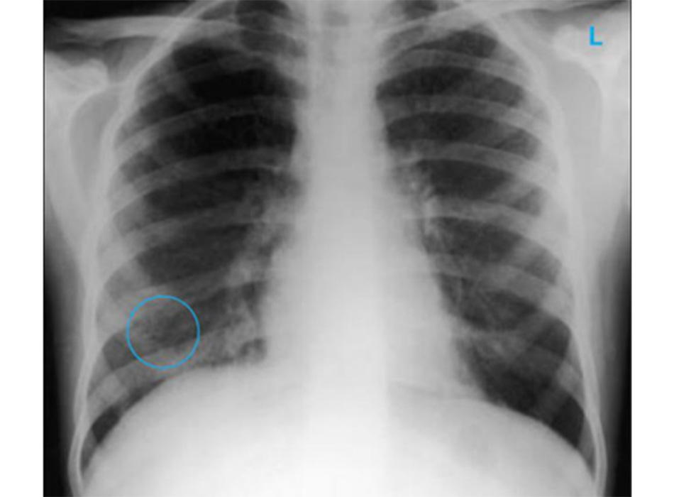 Hình 8: XQ ngực thẳng cho thấy nhiều nốt rải rác khắp hai phổi (một trong số đó được khoanh tròn) ở bệnh nhân bị bệnh lao kê E. Dick, Student BMJ. 2001;9:10-12