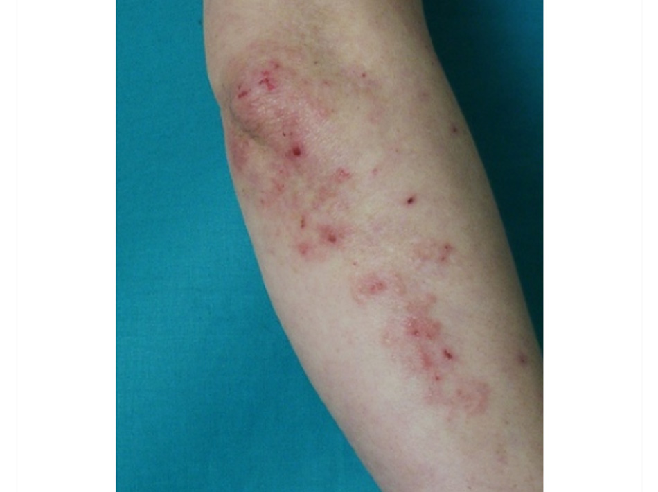 Hình 16: Viêm da dạng Herpes: tổn thương điển hình trên bề mặt cơ duỗi của cẳng tay Trích từ tư liệu của Bác sĩ, tiến sĩ Adam Reich