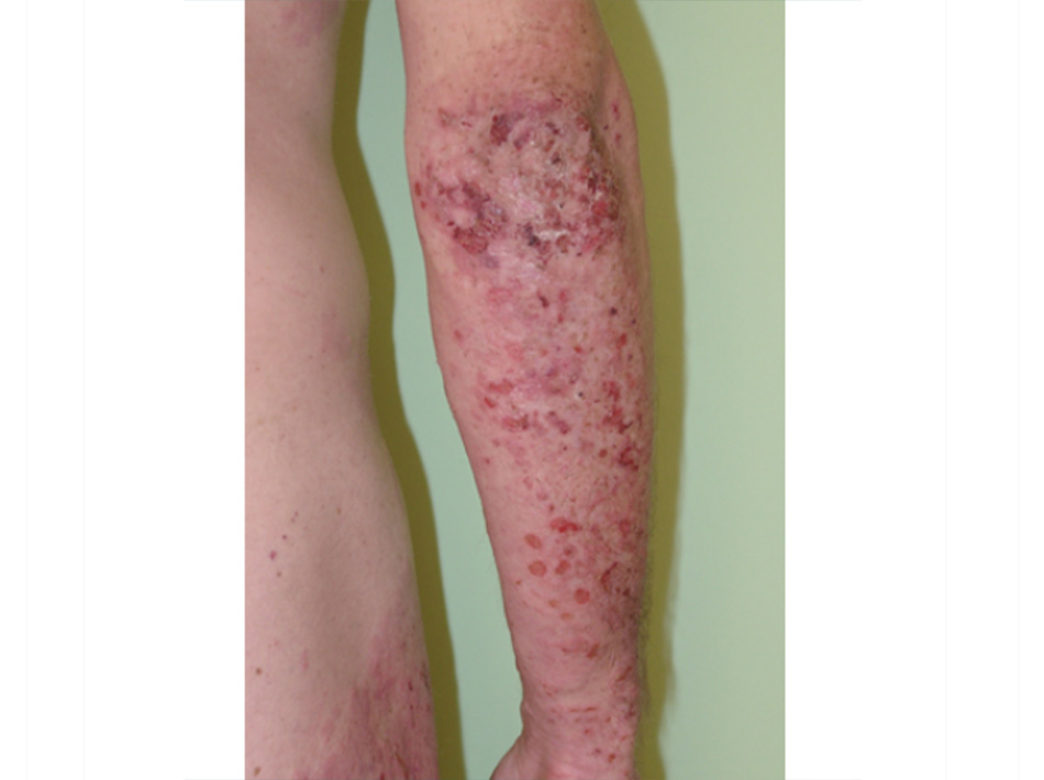 Hình 17: Viêm da dạng Herpes: mụn nước cực kỳ ngứa, các mụn nước nhỏ và bào mòn trên bề mặt cơ duỗi của các chi Trích từ tư liệu của Bác sĩ, tiến sĩ Adam Reich