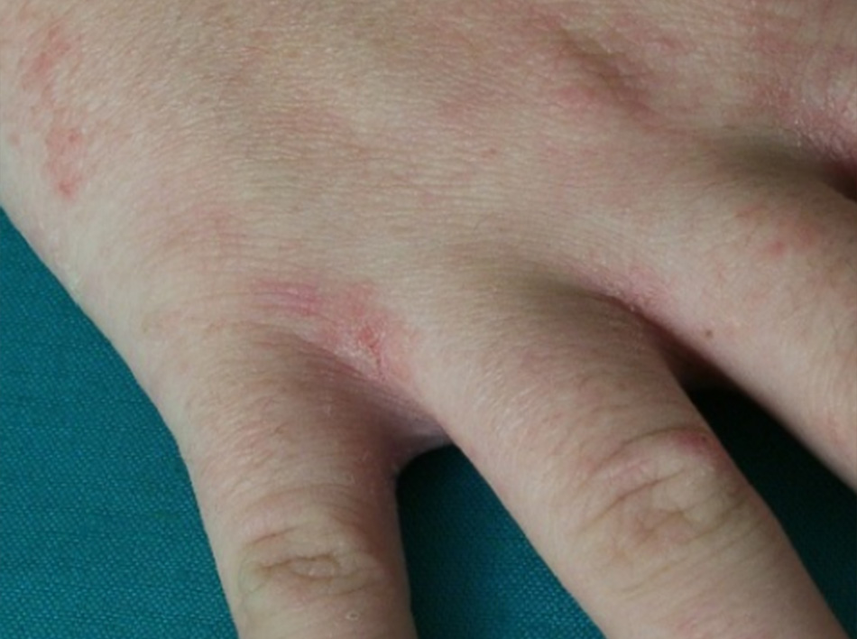 Hình 4: Ghẻ: tổn thương điển hình trong vùng gian đốt ngón Trích từ tư liệu của Bác sĩ, tiến sĩ Adam Reich