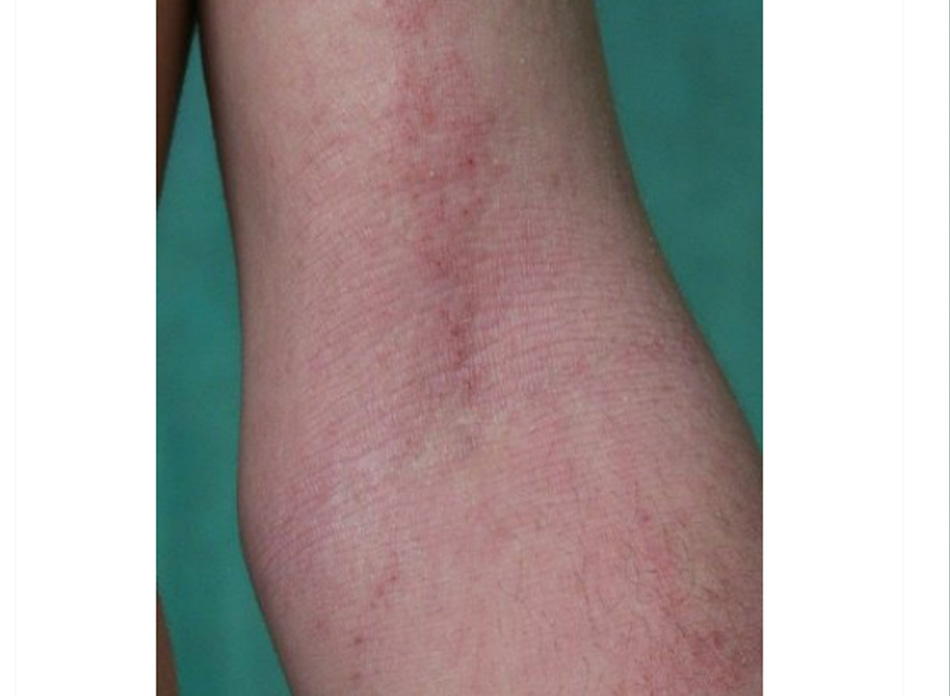 Hình 9: Lichen hóa do thường xuyên chà xát ở bệnh nhân bị viêm da cơ địa Trích từ tư liệu của Bác sĩ, tiến sĩ Adam Reich