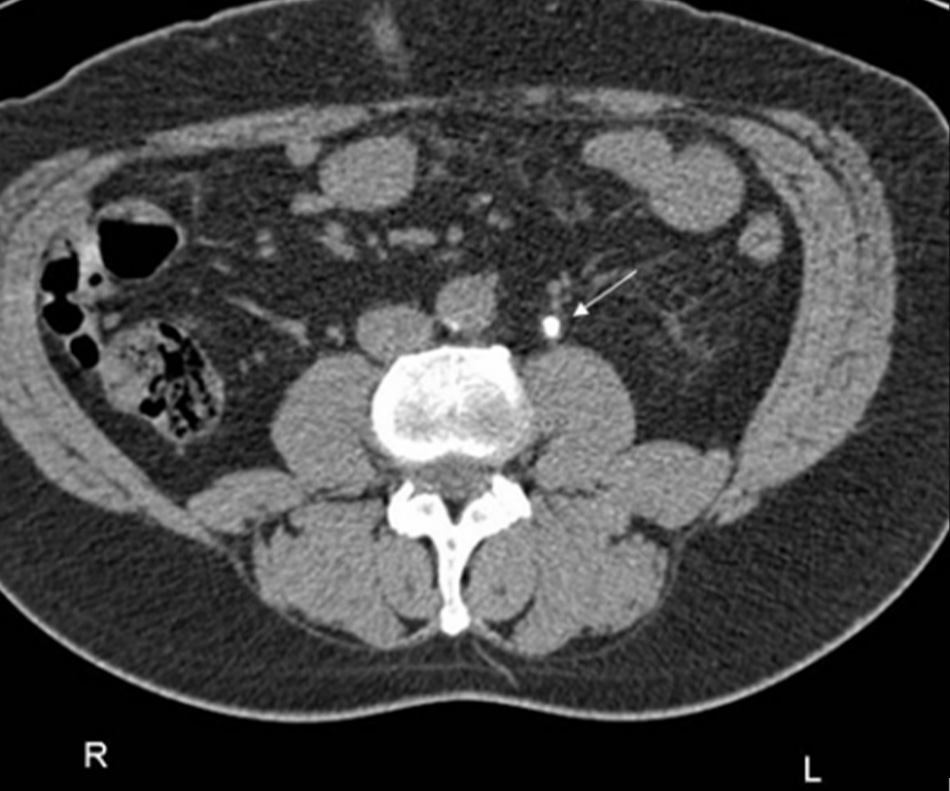 Hình 1: Chụp CT cho thấy sỏi niệu quản bên trái Từ thông tin thu thập cá nhân của bác sĩ Kasra Saeb-Parsy