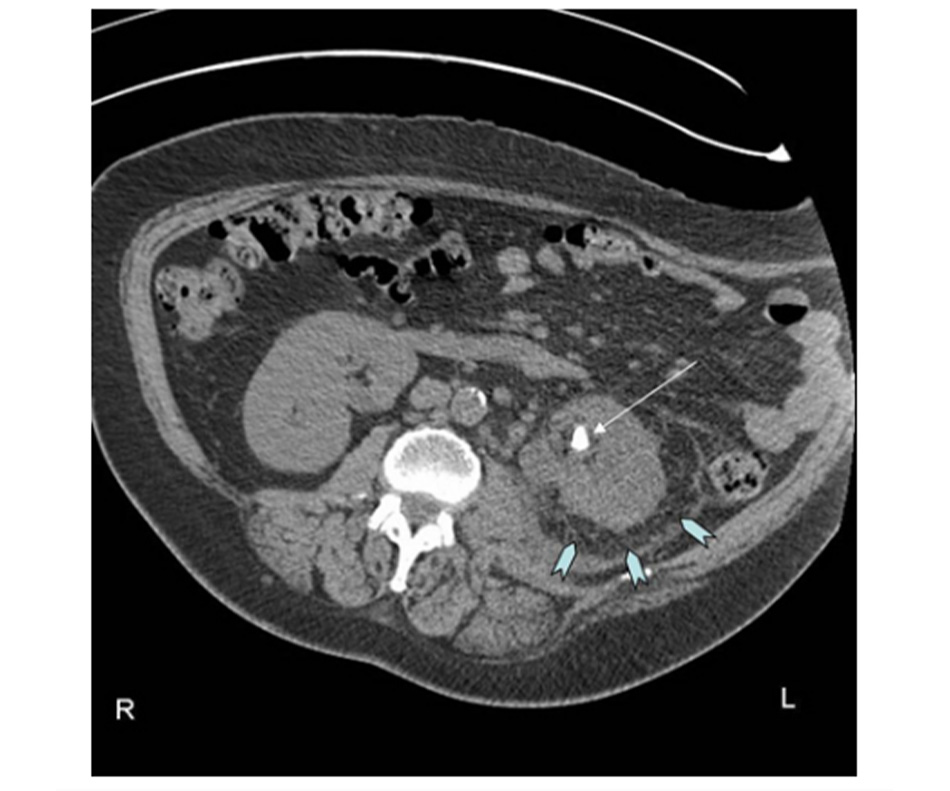 Hình 2: Chụp CT cho thấy sỏi thận trái (mũi tên màu trắng) có thâm nhiễm mỡ quanh thận trái (hình chữ Y màu xanh lam) và viêm thận-bể thận Từ thông tin thu thập cá nhân của bác sĩ Kasra Saeb-Parsy