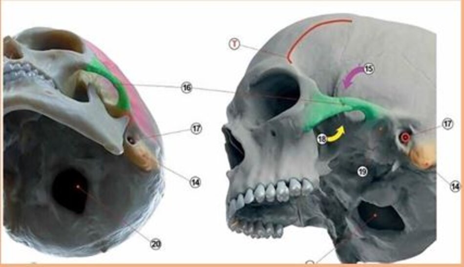 Hình 3,4,5: Mốc xương chính của xương sọ kèm chú thích thuật ngữ.