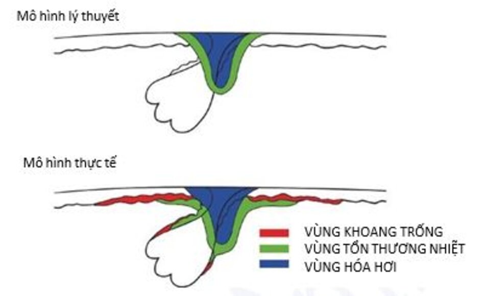Hình 10.13 Phản ứng của da và mô khi tiếp xúc với laser CO2. Mô hình lý thuyết (bên trên) và mô hình thực tế (bên dưới). Được sửa đổi từ [16]