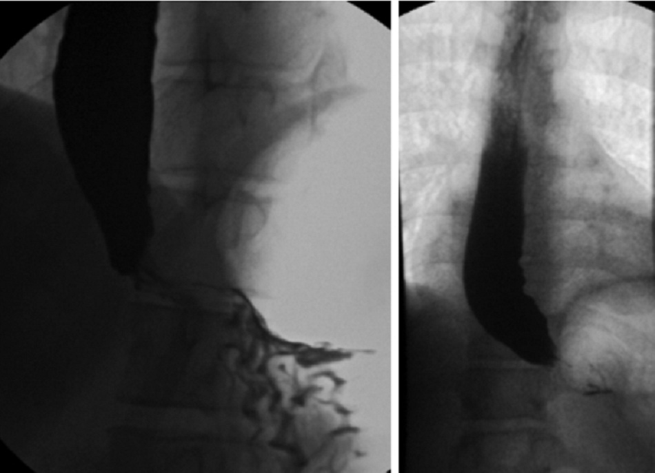 Hình 11: Co thắt thực quản vô căn: chụp X-quang thực quản uống cản quang cho thấy thân thực quản giãn nở và chít hẹp có dạng nón (mỏ chim) ở đoạn dưới thực quản