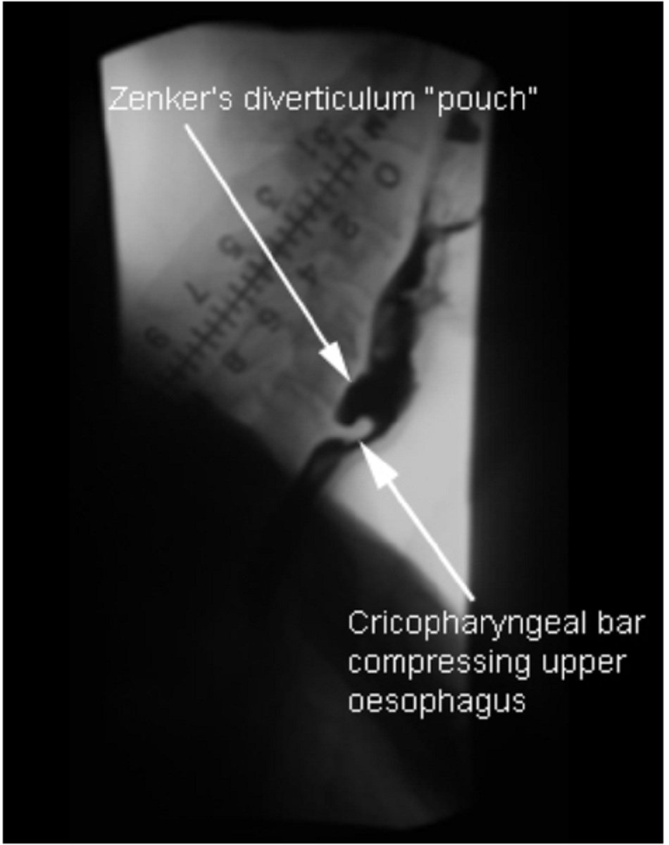 Hình 4: Túi thừa Zenker: nhìn thấy phía bên khi chụp X quang thực quản uống cản quang