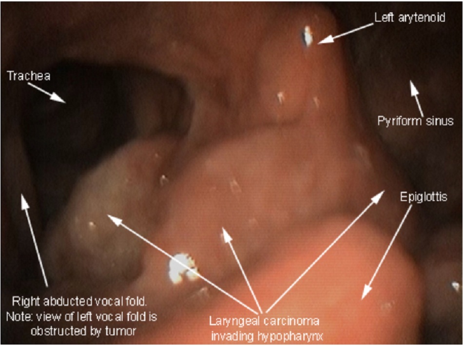 Hình 5: Ung thư biểu mô tế bào vảy thanh quản/ hầu họng 