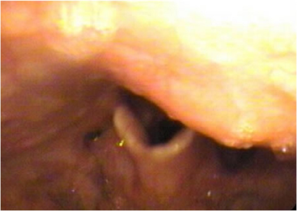 Hình 6: Hình ảnh nội soi họng cho thấy gai xương chèn vào trong thành sau họng, che khuất thanh quản cùng với nắp thanh môn