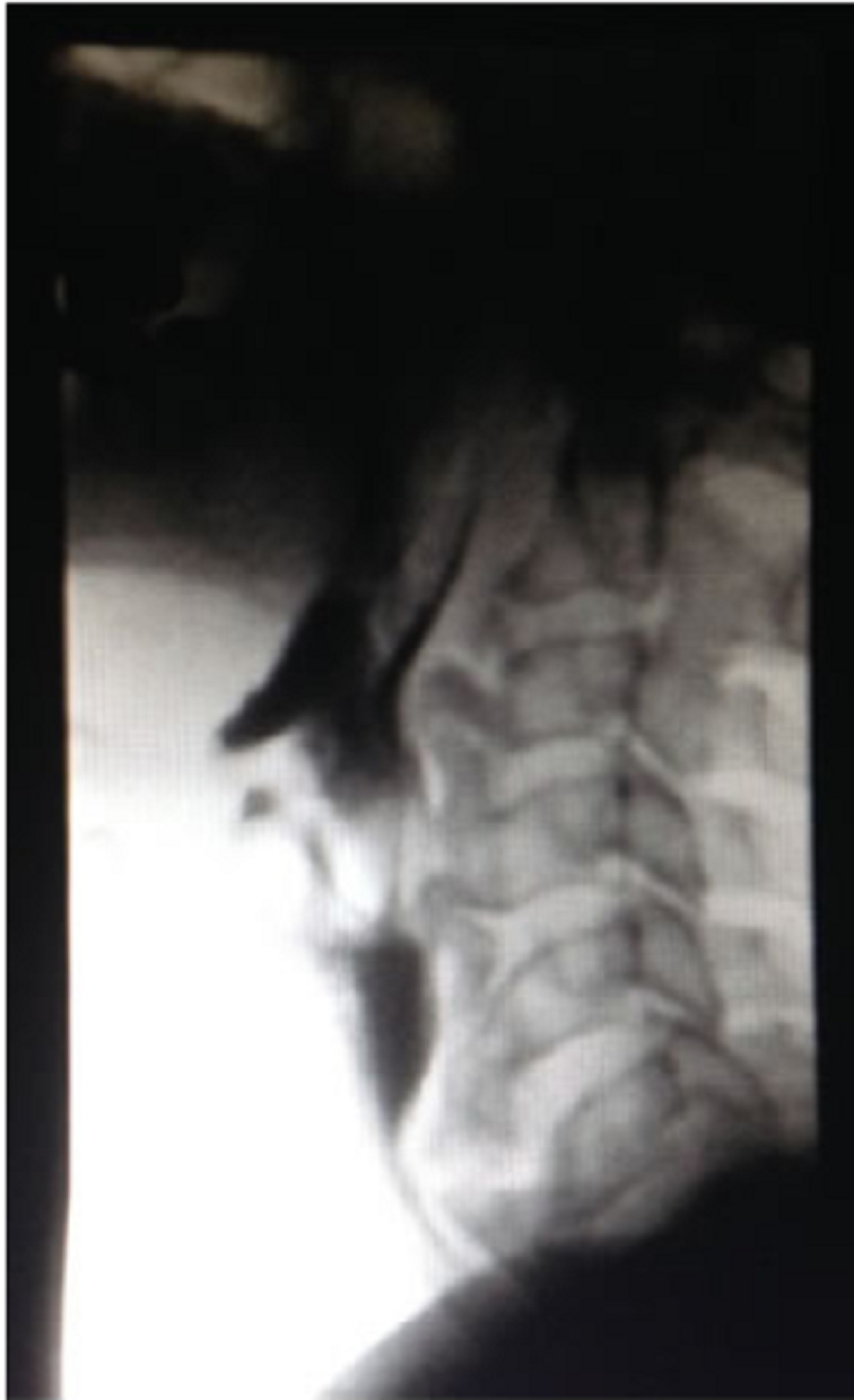 Hình 7: Chụp X quang thực quản uống cản quang nghiêng, cho thấy gai xương choáng chỗ dòng cản quang đoạn thực quản trên
