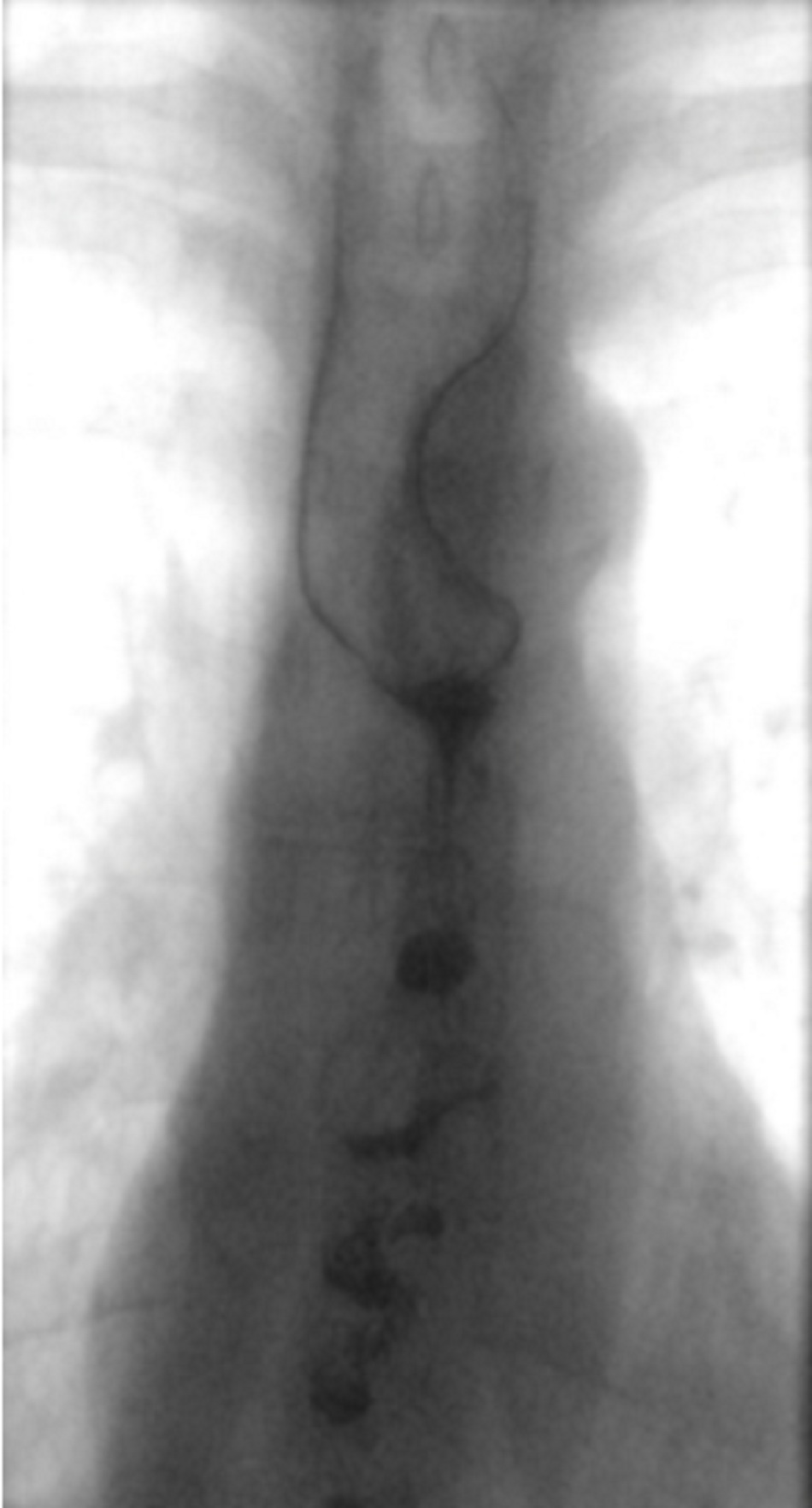 Hình 9: Thực quản có hình cái mở nút chai do co thắt thực quản lan toả khi chụp X quang thực quản uống cản quang