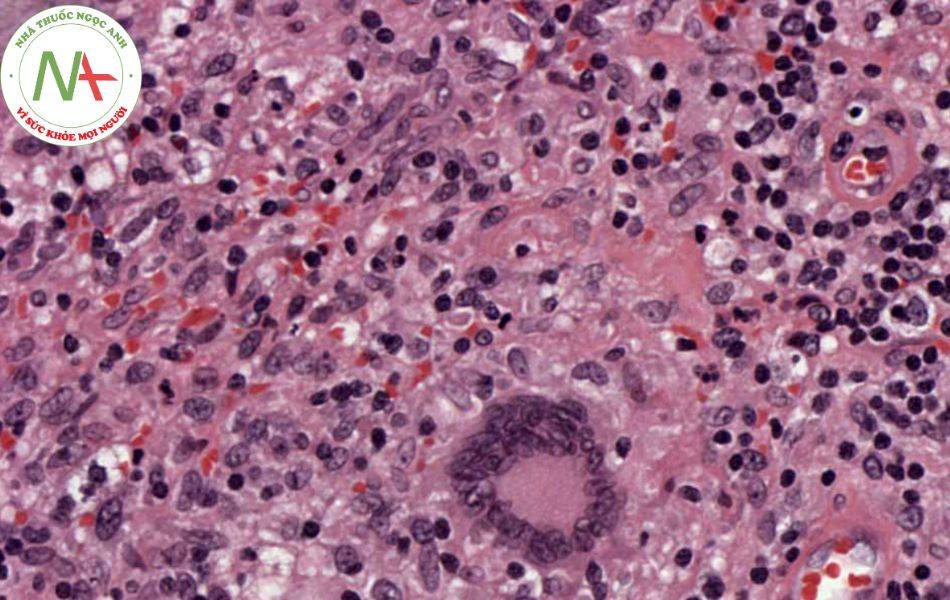 Hình ảnh u tế bào khổng lồ Langhans