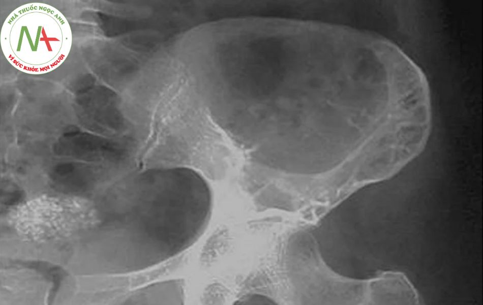 Chẩn đoán u tế bào khổng lồ bằng cách chụp X-quang
