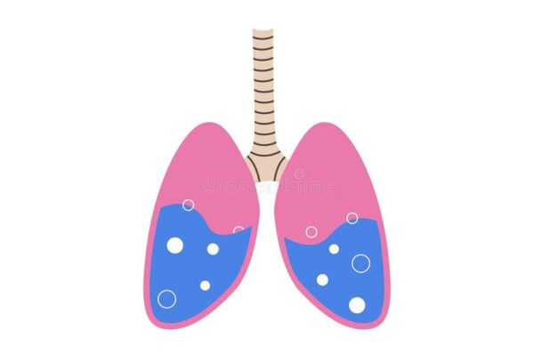 Phù phổi cấp có cơn cường giao cảm