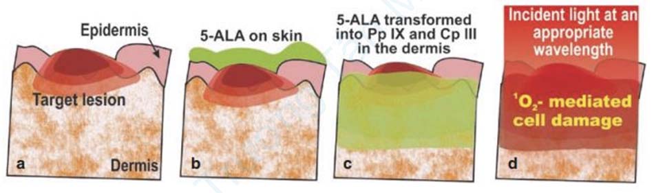 Hình 18.15 Sự xâm nhập không chọn lọc vào da của Pp IX và Cp III có nguồn gốc 5-ALA.